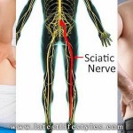 Sciatic Nerve Pain Effective Treatment